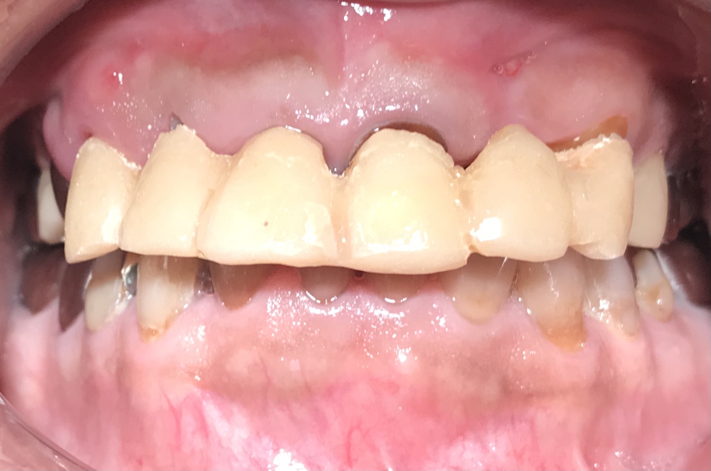 治療中の仮歯