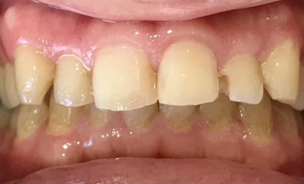 代男性 歯が欠けた 虫歯治療の症例 竹ノ塚の歯医者さん おおすみファミリー歯科